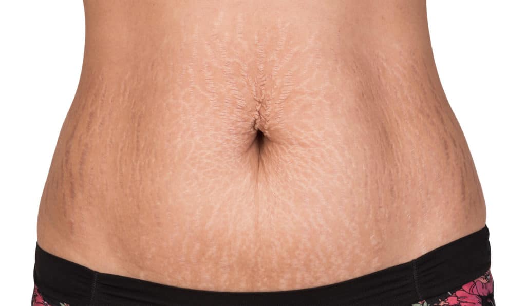 Sculptra : A one-stop solution for your Stretch marks and damaged skin