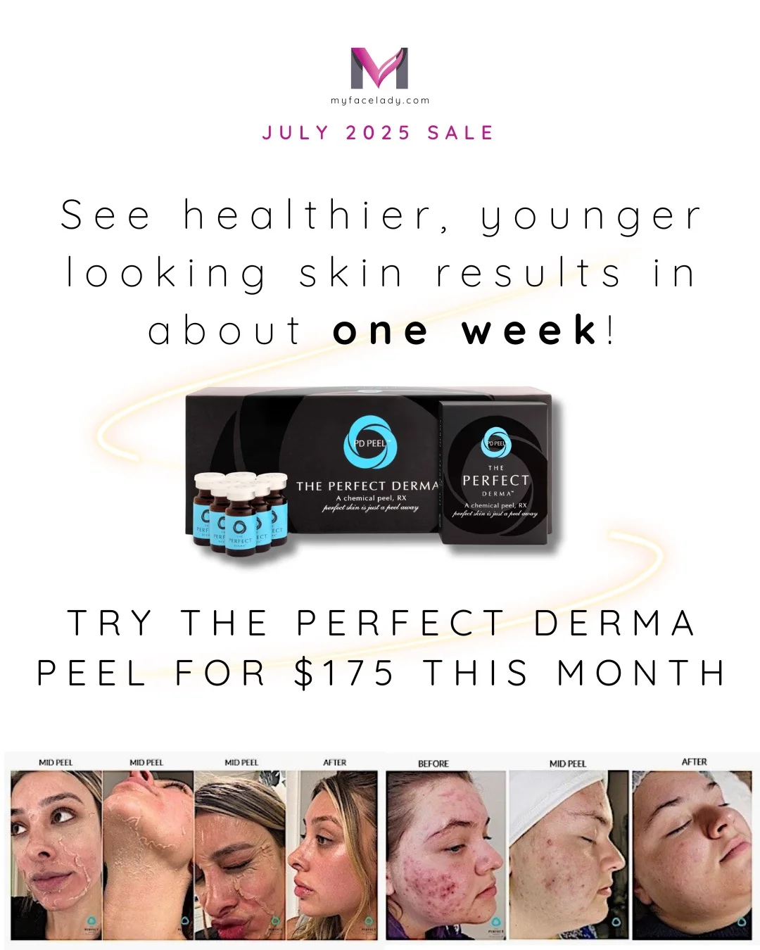 July 2025 promo for The Perfect Derma Peel at $175 with before and after results.