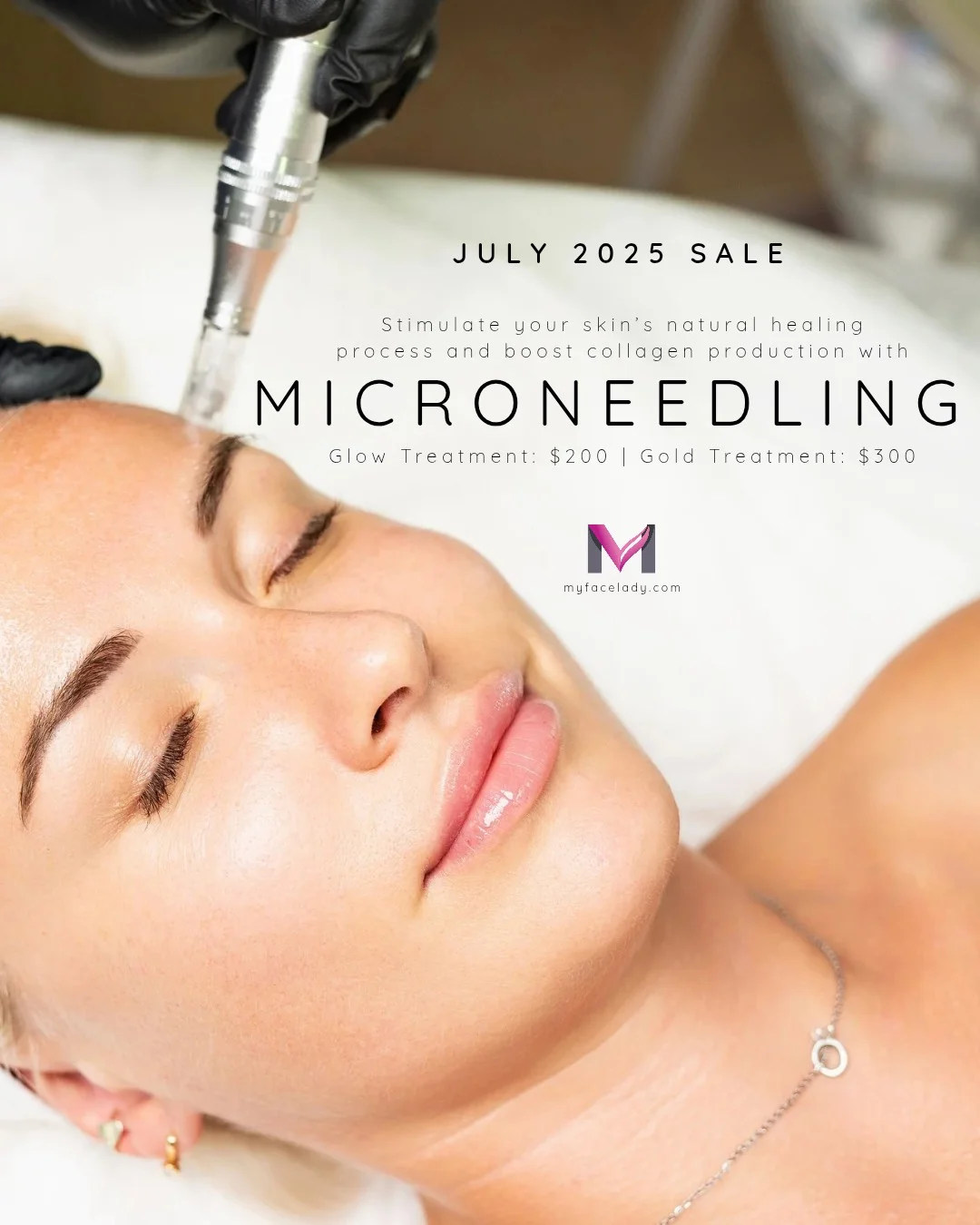 July 2025 promo for Microneedling