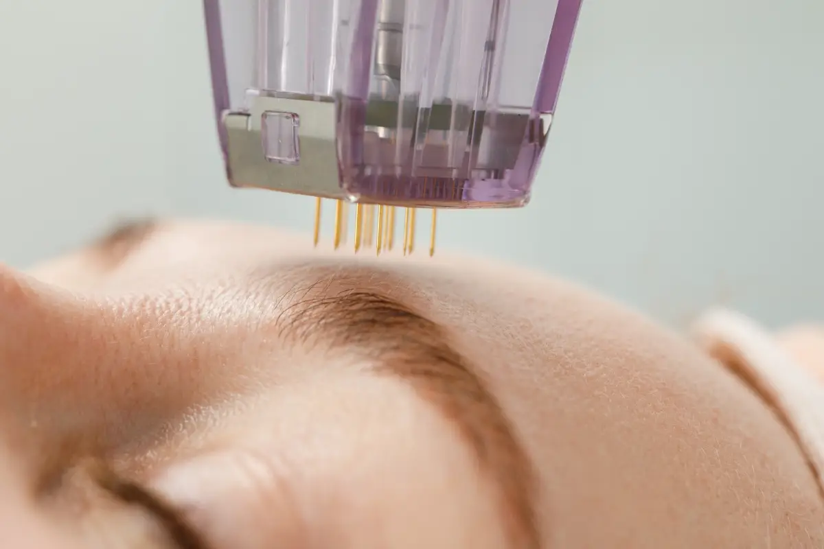 Microneedling The Secret to Smoother Younger Looking Skin Revealed