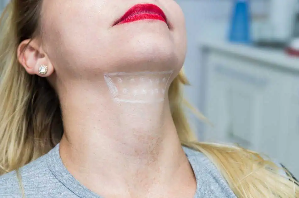 Kybella Injections in Houston, TX by My Face Lady