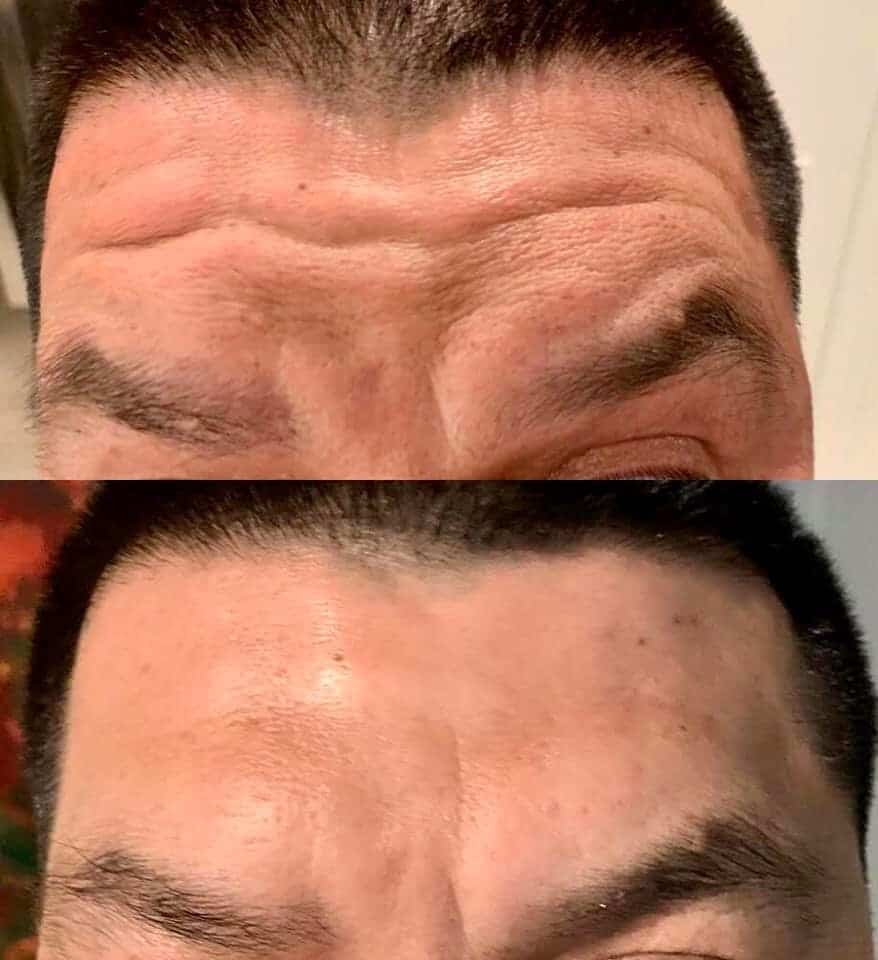 Mark-forehead