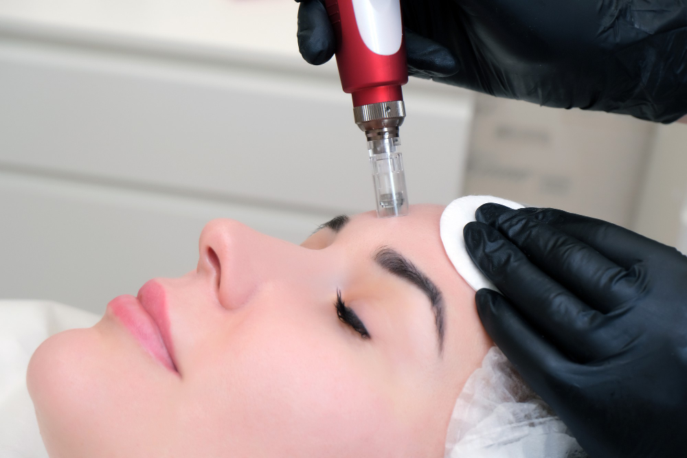 Microneedling in Texas & Louisiana | My Face Lady Concierge Medspa