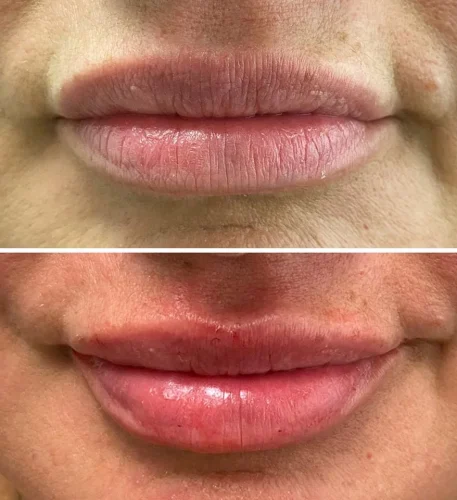 Anne-lips