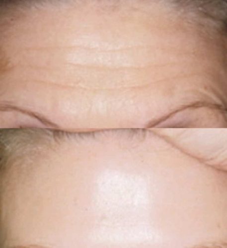 Forehead