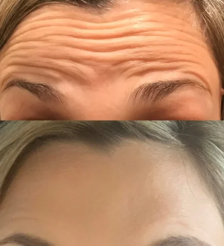 ann-forehead-dysport