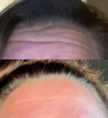 holly-forehead